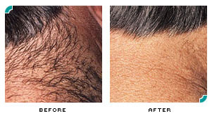 Laser Hair Removal | Dermatologist In Gaithersburg, MD | Center for  Cosmetic and Clinical Dermatology